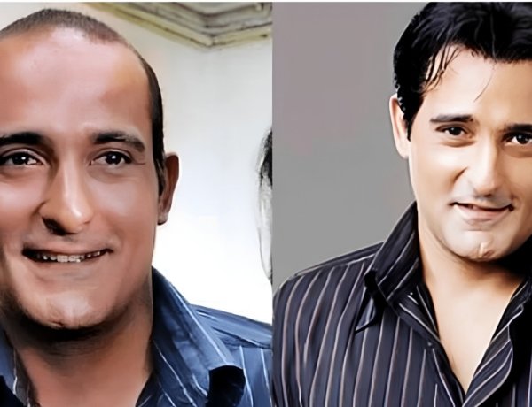 The Secret Behind Bollywood’s Perfect Hair Why Hair Patches Are Becoming the Go-To Solution