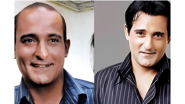 The Secret Behind Bollywood’s Perfect Hair Why Hair Patches Are Becoming the Go-To Solution